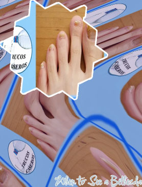 Best way to kill toenail fungus