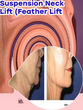 Direct neck lift cost