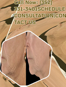 Loose skin on neck surgery cost